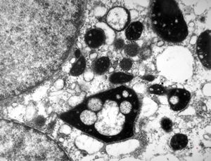 F,14y. | megamitochondria - Wilson disease F,14y. | megamitochondria - Wilson disease